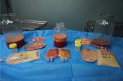 了解奥美定取出手术的多种有效方法