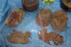 专业奥美定取出医院，安全重塑健康生活