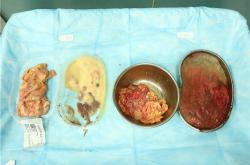 “奥美定取出后疼痛缓解时间及相关风险解析”