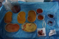 奥美定取出后恢复健康时间及相关并发症与费用分析