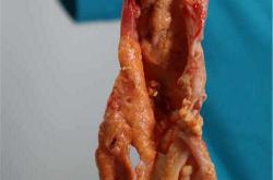 “奥美定取出：症状辨识、危害分析及费用详解”