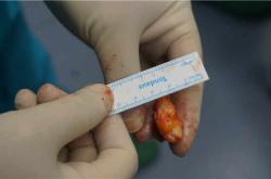 奥美定取出后组织干瘪的危害及修复费用解析