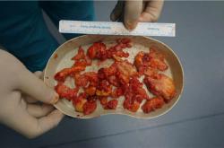 奥美定取出后再隆胸的费用、风险与并发症解读