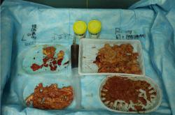 警惕丰体针丰胸后的感染危险，症状与处理一览