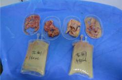 奥美定取出后恢复期及潜在并发症分析