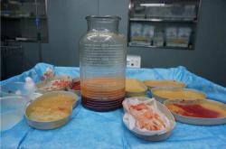 奥美定取出后脂肪填充丰胸的风险、费用及注意事项