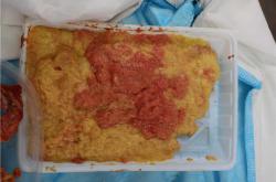 奥美定取出后乳腺检查需注意的症状与并发风险