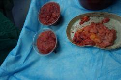 丰体针丰胸的不良反应及如何有效监控症状