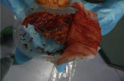 专家提醒：丰体针丰胸手术的潜在危害及防范