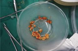 奥美定取出后积液变硬的危害及处理费用解析