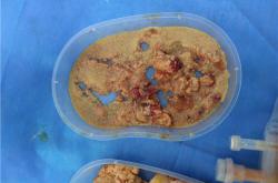 奥美定取出后乳房变化及可能引发的并发症与费用分析