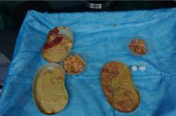 「奥美定取出手术风险及可能并发症费用解析」