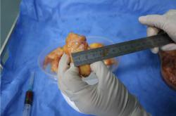 奥美定取出后脂肪填充的恢复时间、风险与费用分析