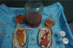 如何有效减少丰体针丰胸手术后的副作用