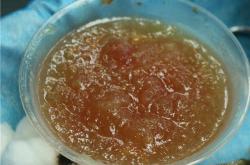 丰体针丰胸导致的血液循环障碍及解决方案