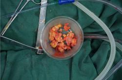 丰胸后遗症？丰体针丰胸常见后遗症详解