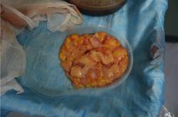 丰体针丰胸的高风险，术前术后需特别注意事项