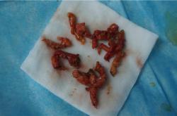 “奥美定取出注意事项：症状监测、费用解析与并发症防护”