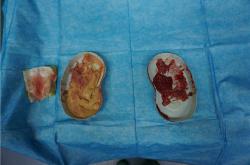 奥美定取出方法及费用、危害与并发症详解