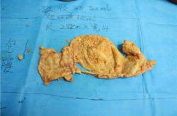 丰体针丰胸过程中的风险评估及如何降低危害