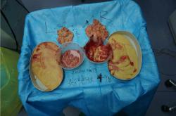 丰体针丰胸后的免疫反应症状及综合应对措施