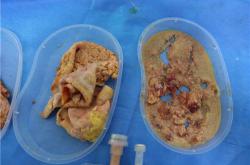 奥美定取出后硬块现象：症状与并发症解析