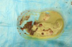 奥美定取出后乳房硬涨疼的症状与潜在并发症分析