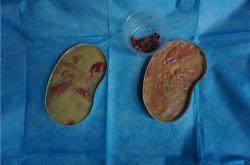 奥美定取出后硬块：症状分析与处理建议