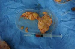 奥美定取出后乳房护理：预防并发症与费用详解