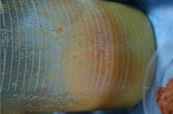 奥美定取出后的注意事项及潜在风险分析