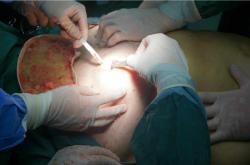 奥美定取出后的修复：症状管理与并发症预防费用解析