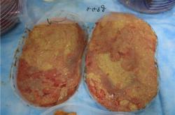 奥美定取出后乳房会松弛吗：症状、危害及费用分析