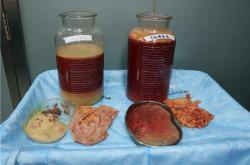 奥美定取出后如何科学护理以防并发症和控制费用