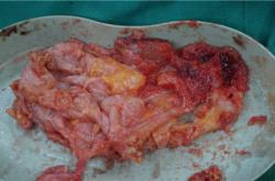 奥美定取出后束胸时间及相关并发症与费用分析