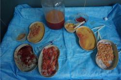 取出奥美定后再植入假体：评估风险与必要性