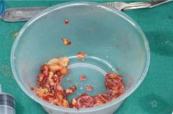 深入解析奥美定取出：出院时间、症状与费用详解