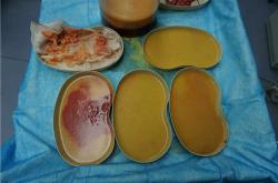 奥美定取出后的乳房变化：症状表现及风险评估