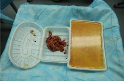 奥美定取出后的药物应用： 控制并发症与恢复费用解析