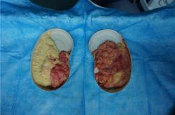 奥美定取出后的恢复期：症状监测与并发症防范