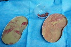 历经20年，上海哪家医院最擅长取出英捷尔法勒注射隆胸？