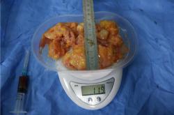 奥美定取出后的恢复与并发症及工作重返指南