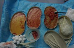 奥美定取出后的护理建议：症状管理、潜在危害及费用考量