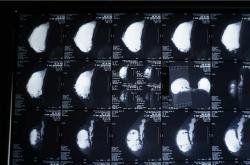 “奥美定取出后常见后遗症及潜在并发症解析”