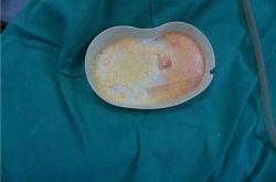 探讨乳房填充物取出术的潜在风险与安全性