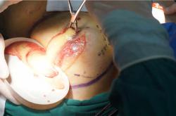 奥美定取出后胸部凹陷：症状分析与修复方案