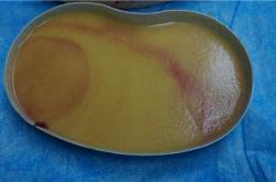 奥美定取出前的核磁共振检查：症状评估与并发症解析