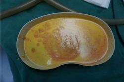 奥美定取出手术是全麻还是半麻？费用、风险及并发症解读