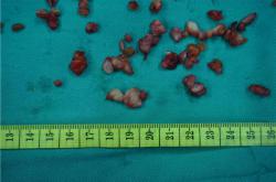 奥美定取出后的症状与潜在危害全解析