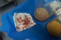 奥美定取出术：症状诊断及并发症解析与治疗费用分析