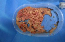 奥美定取出手术的费用及潜在并发症浅析